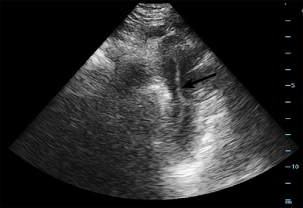 Cureus Point Of Care Ultrasound Diagnosis Of Type B Aortic Dissection