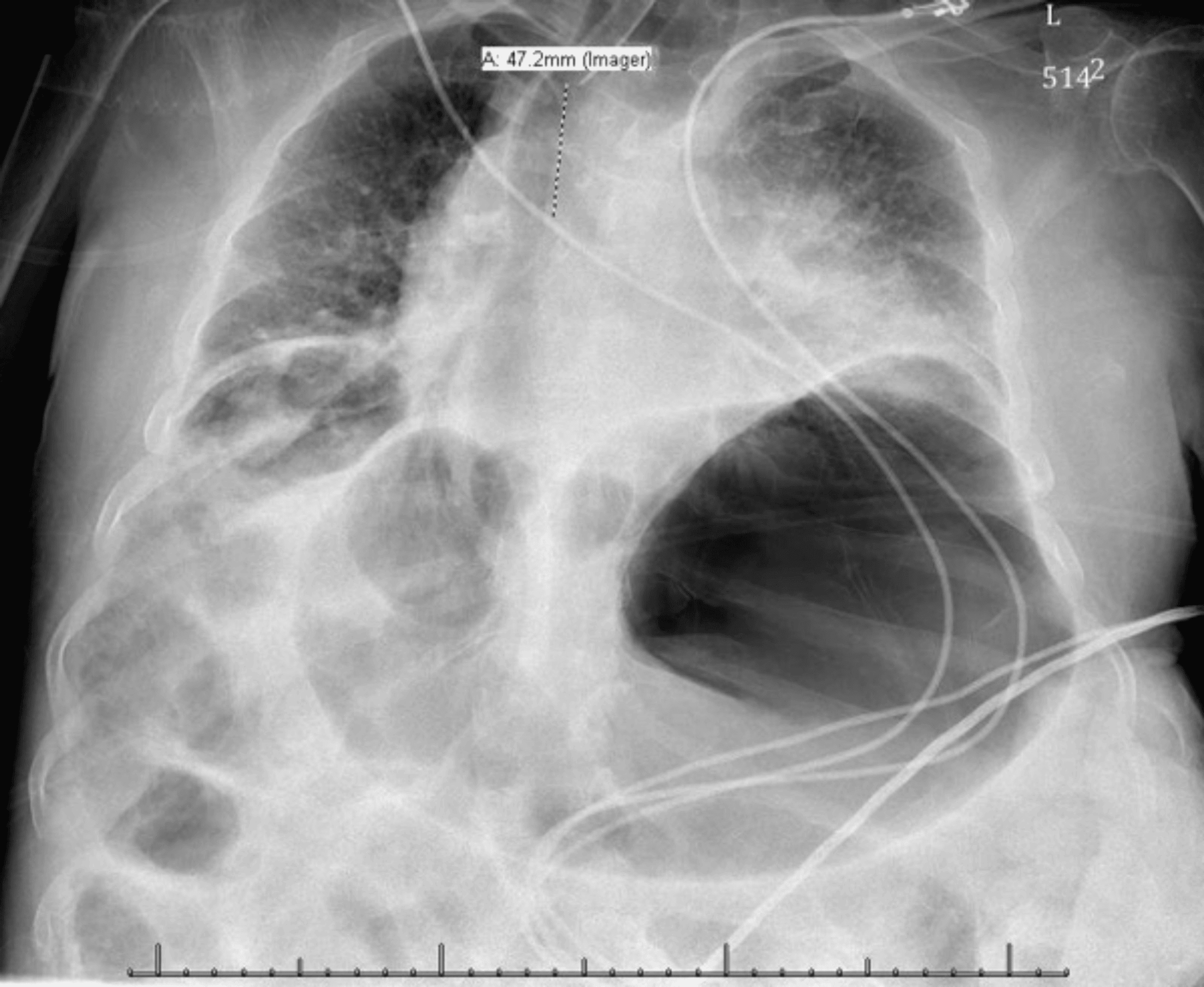 Cureus Delayed Extubation of a Patient With Multiple Sclerosis