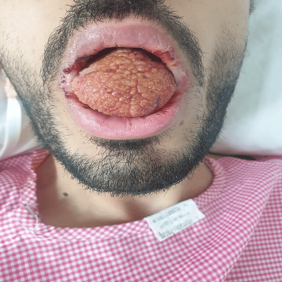 Choroba Castlemana ze zmianami w języku u pacjenta zakażonego wirusem HIV z Arabii Saudyjskiej