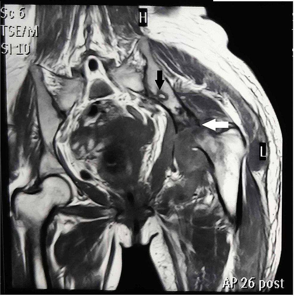 Cureus | A Rare Case Report on Xanthogranulomatous Osteomyelitis of Hip ...