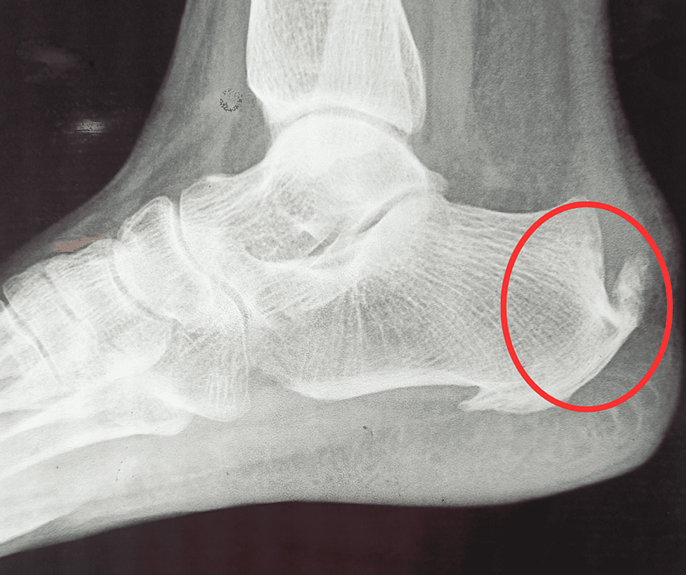 Heel Spurs - Family Foot and Ankle Care of Greenville