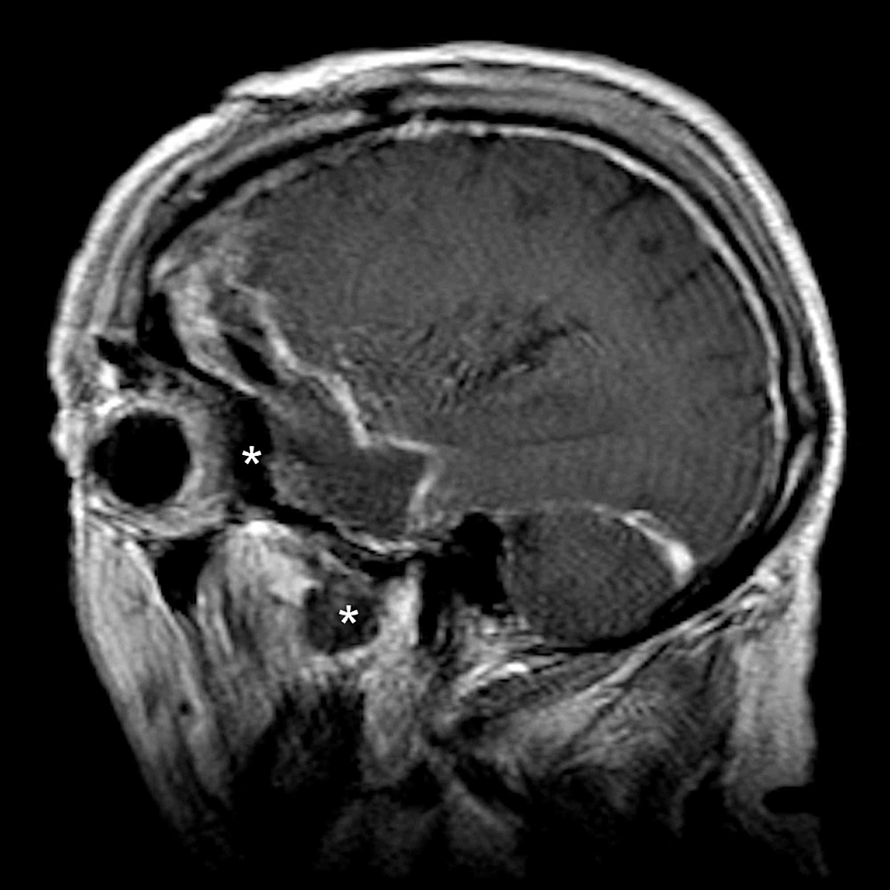 Cureus | Stimulated Raman Histology for Intraoperative Guidance in the ...