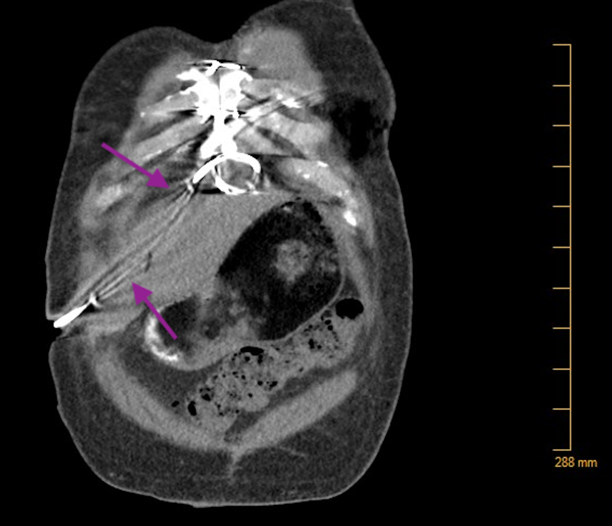 Cureus Driveline Sepsis Presenting As Gout