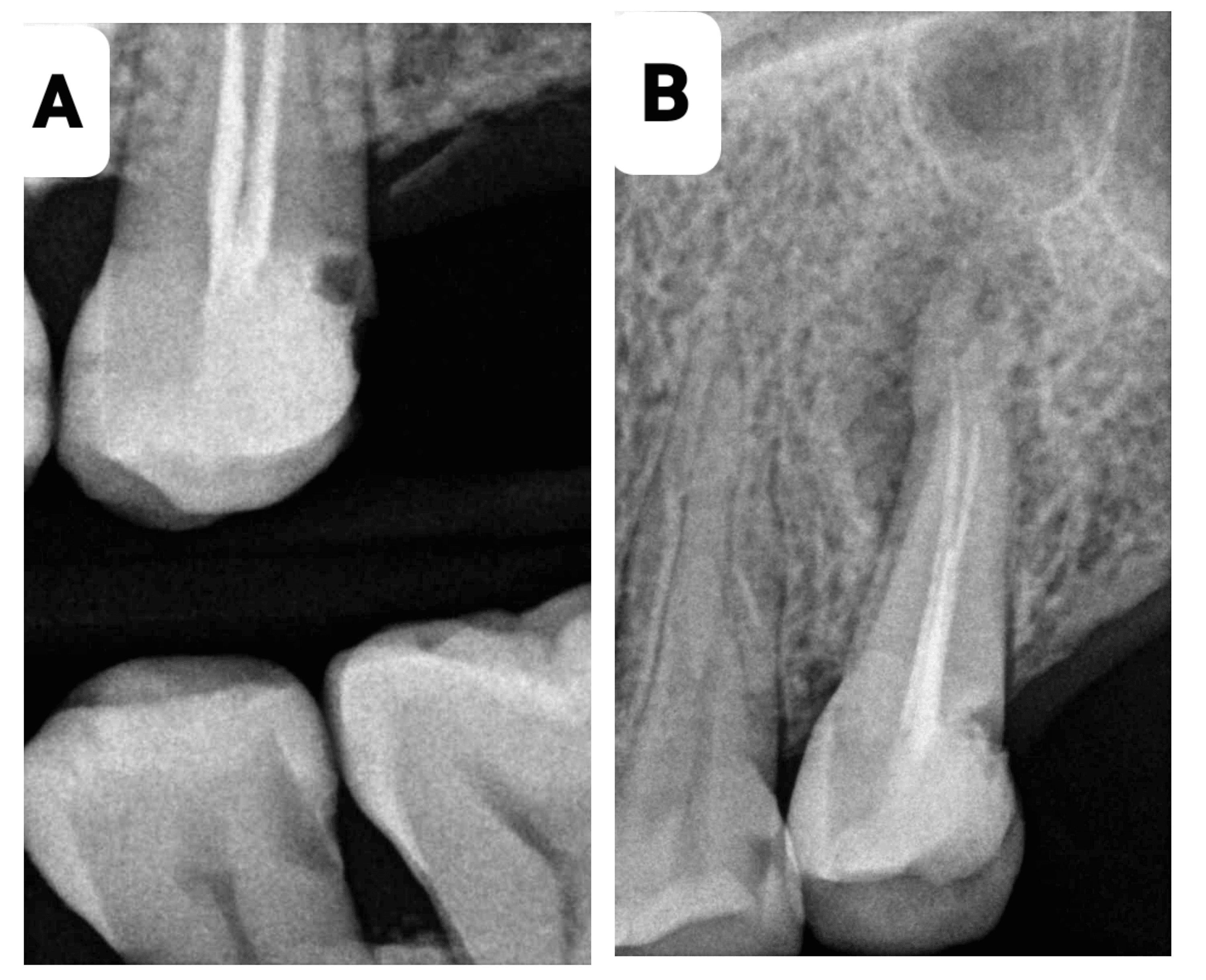 Cureus Management of Endodontic FlareUp in the Presence of