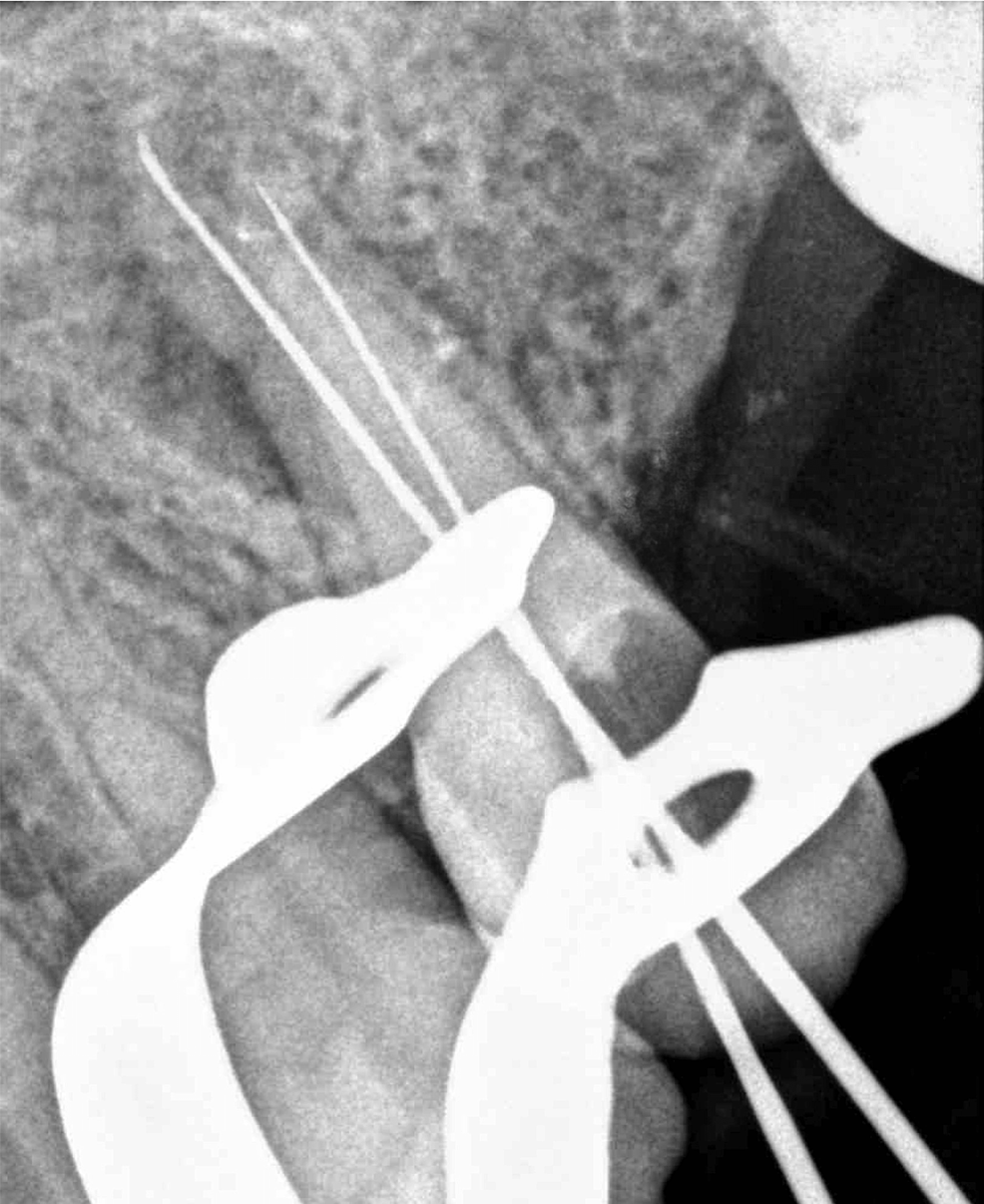 Cureus Management of Endodontic FlareUp in the Presence of