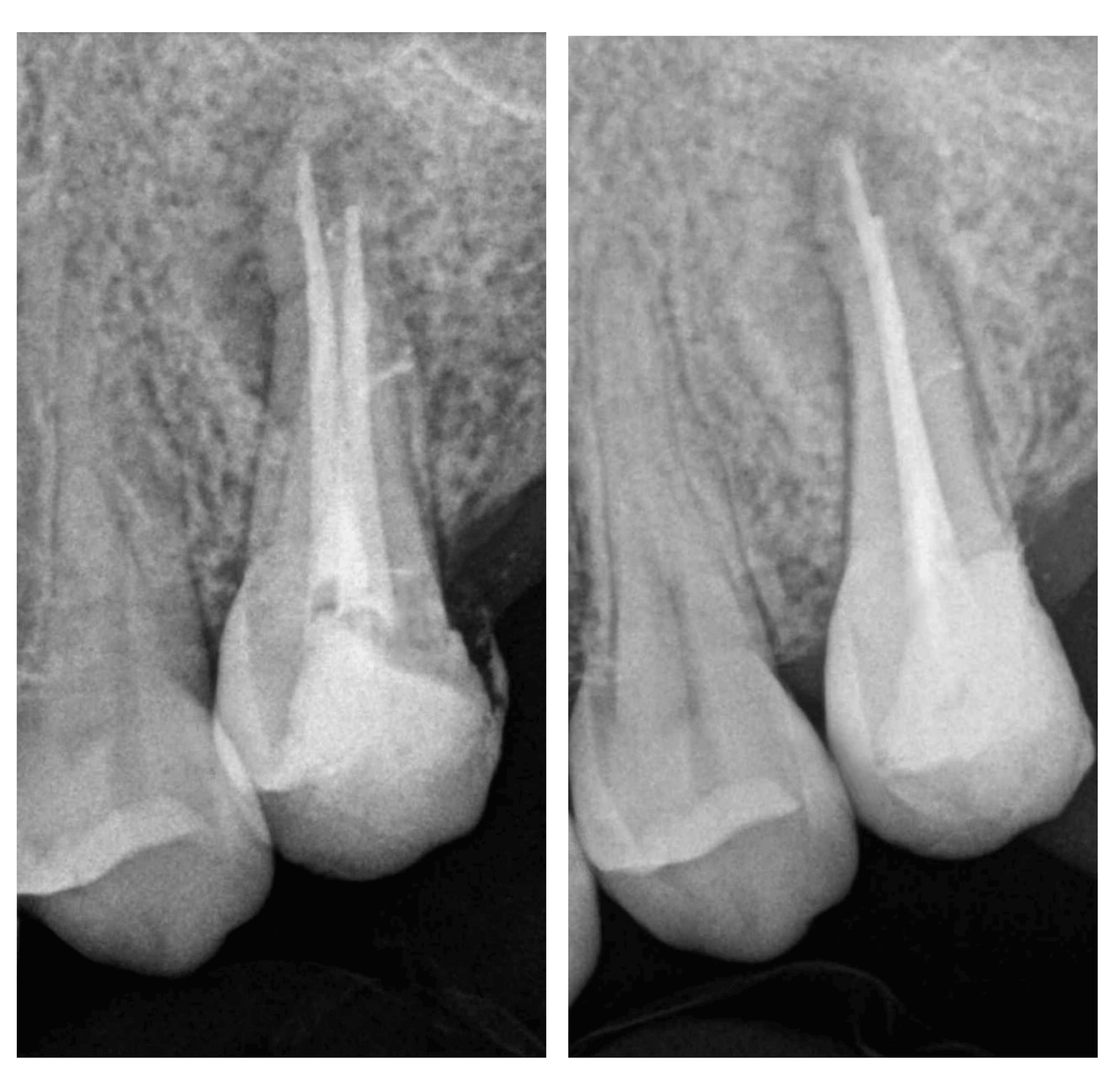 Cureus Management of Endodontic FlareUp in the Presence of