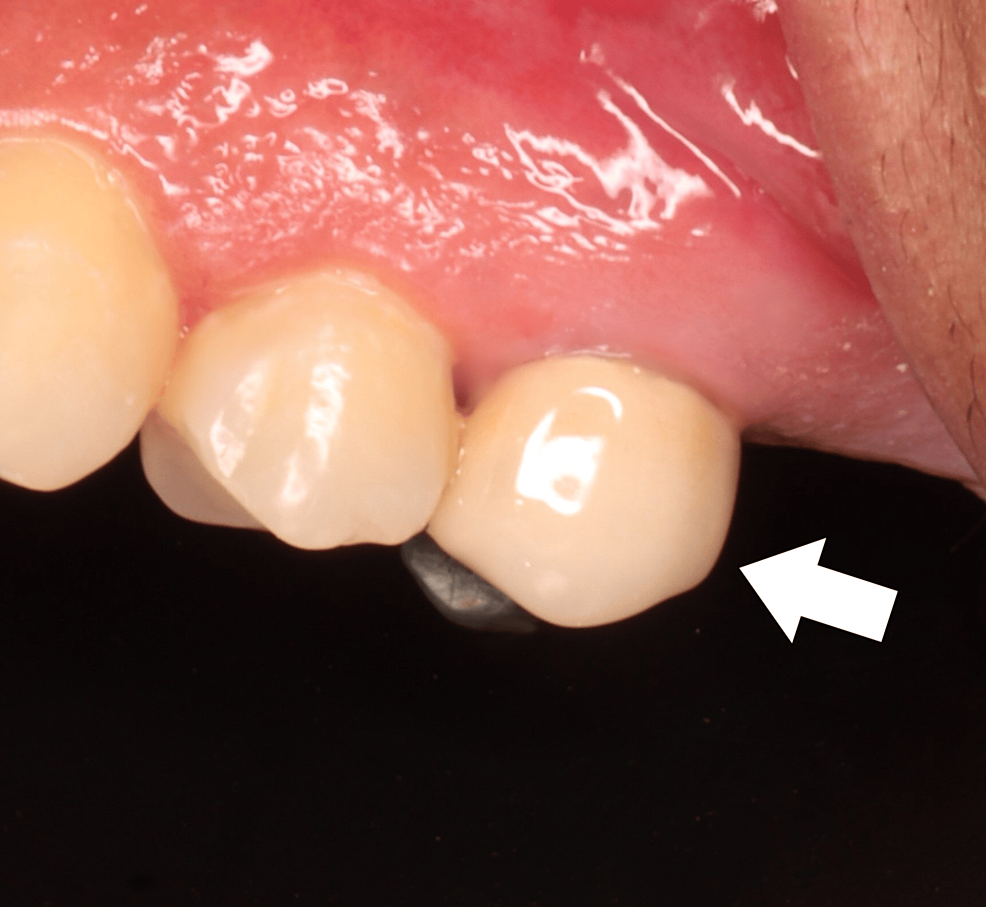 Cureus Management of Endodontic FlareUp in the Presence of