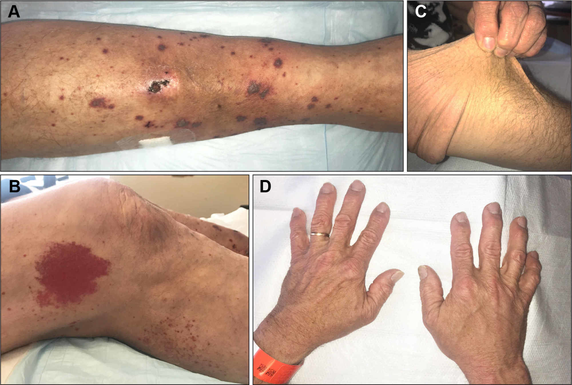 stressende industri violinist Cureus | Case Report: Drug-induced Leukocytoclastic Vasculitis in a Patient  with Classic Ehlers-Danlos Syndrome | Article