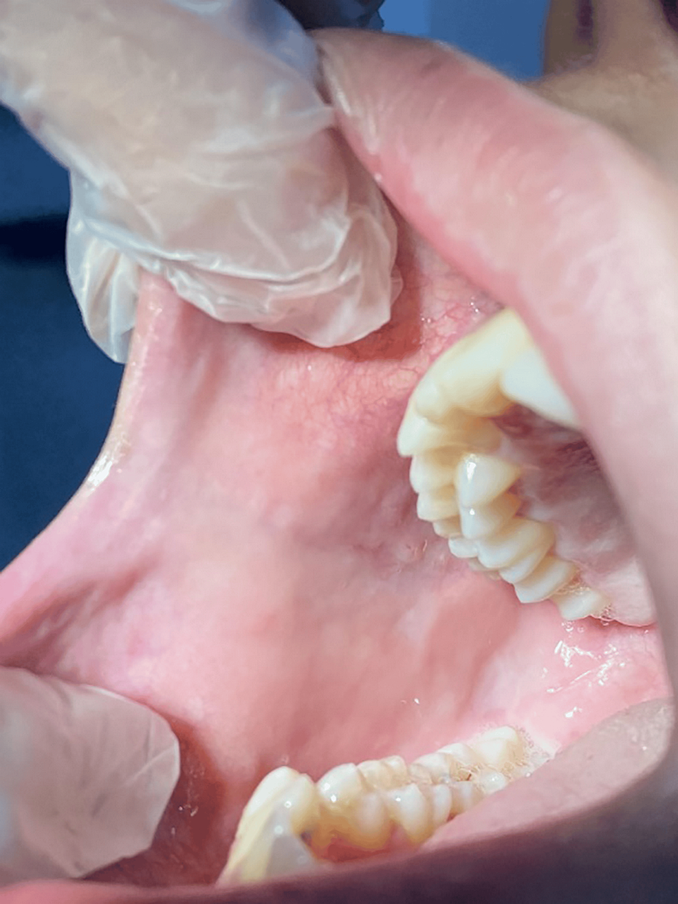 Mycophenolate MofetilInduced Aphthous Stomatitis After Kidney