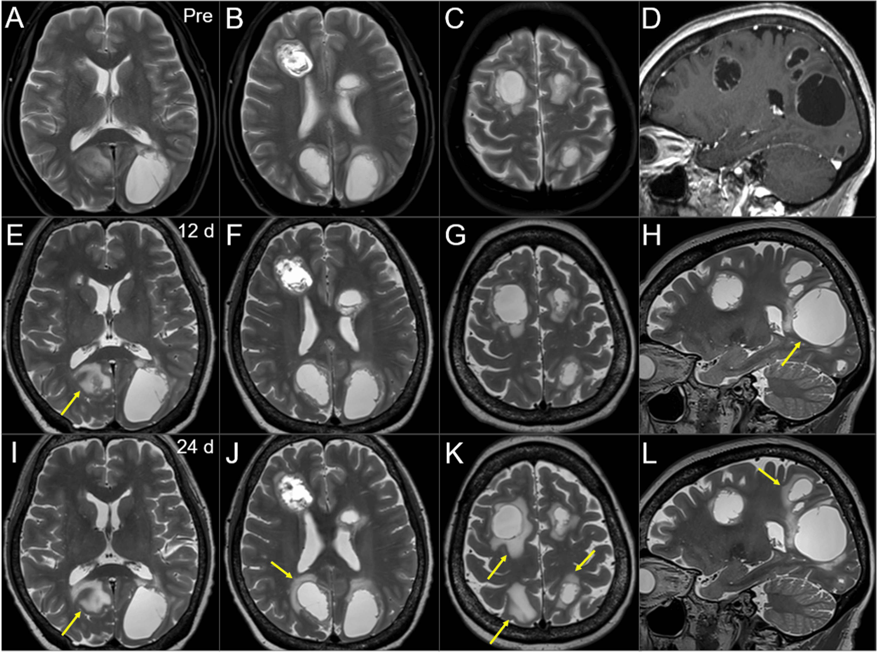 Cureus Robotic Radiosurgical Boost After WholeBrain Radiotherapy for