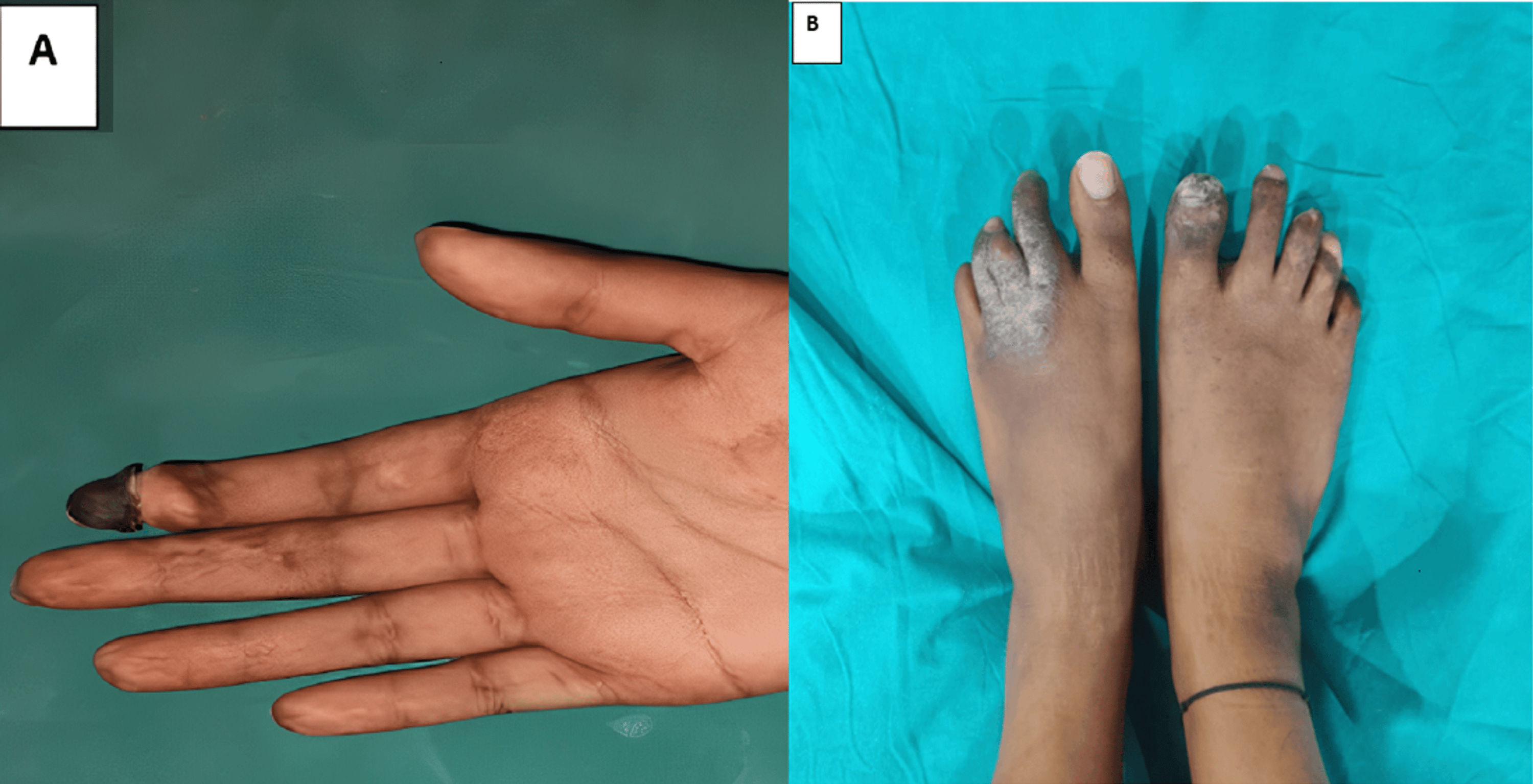 Vasopressin-Induced Gangrene Of The Bilateral Foot Digits And Right ...