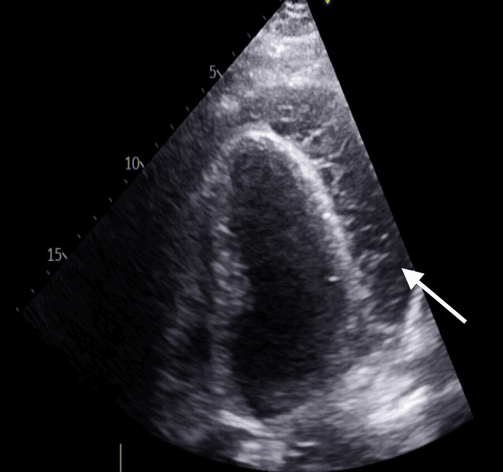 Pericardial Effusion As A First Manifestation Of Rheumatoid Arthritis A Case Report Cureus