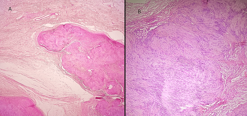 Cureus Giant Plexiform Schwannoma On The Medial Aspect Of The Left Thigh