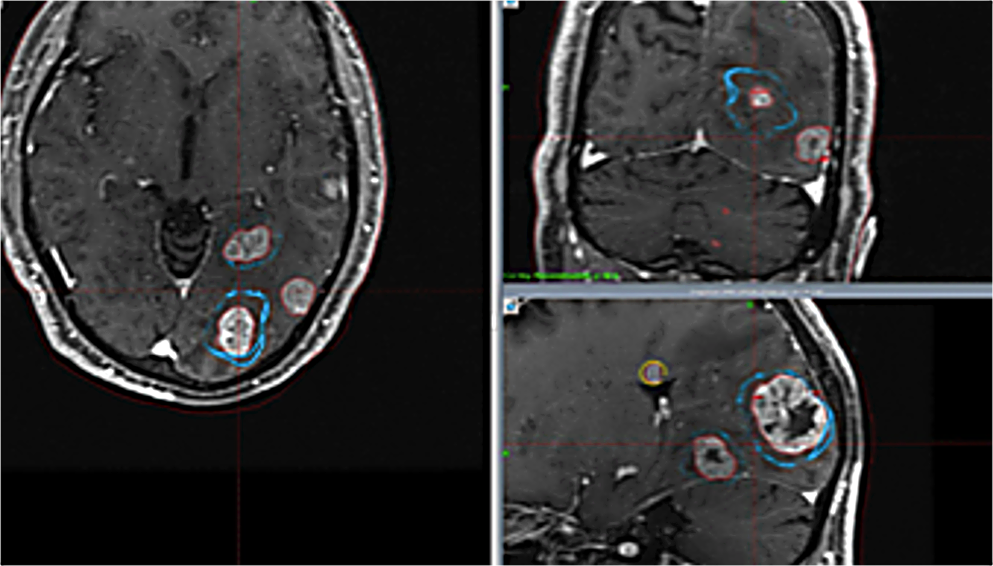 Cureus Radiosurgery for Patients with More Than Ten Brain Metastases