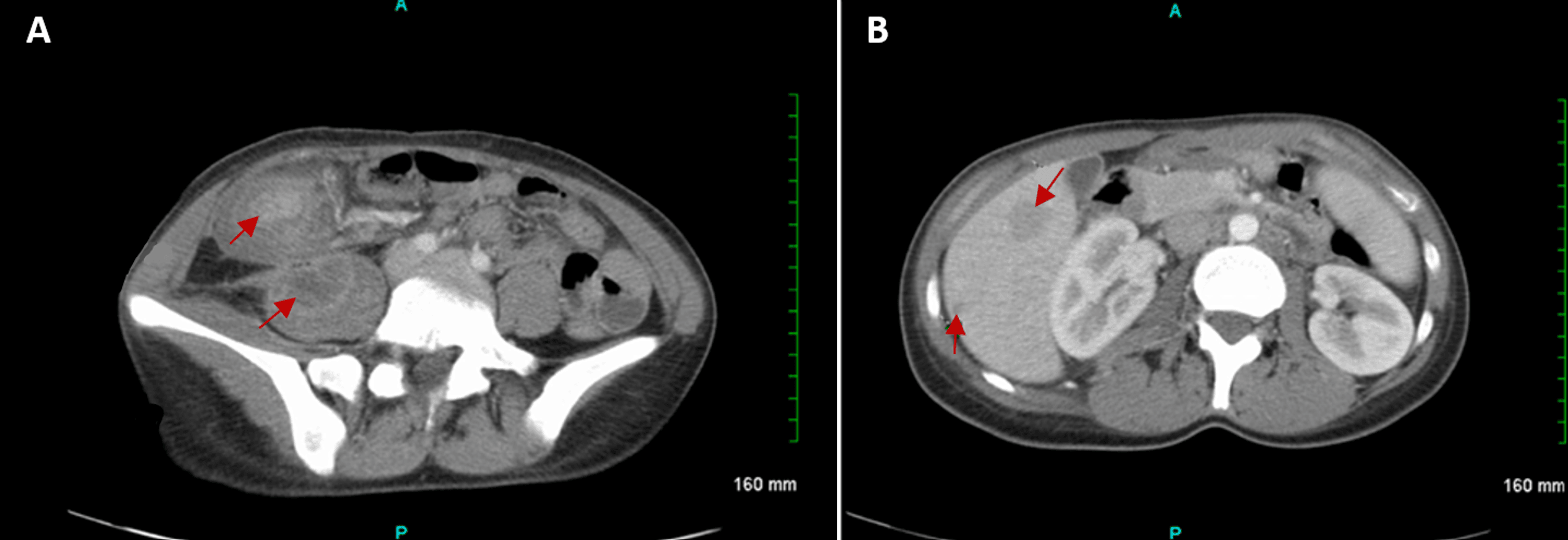 Cureus Tumefactive Crohn's Disease Mimicking Colon Carcinoma in a