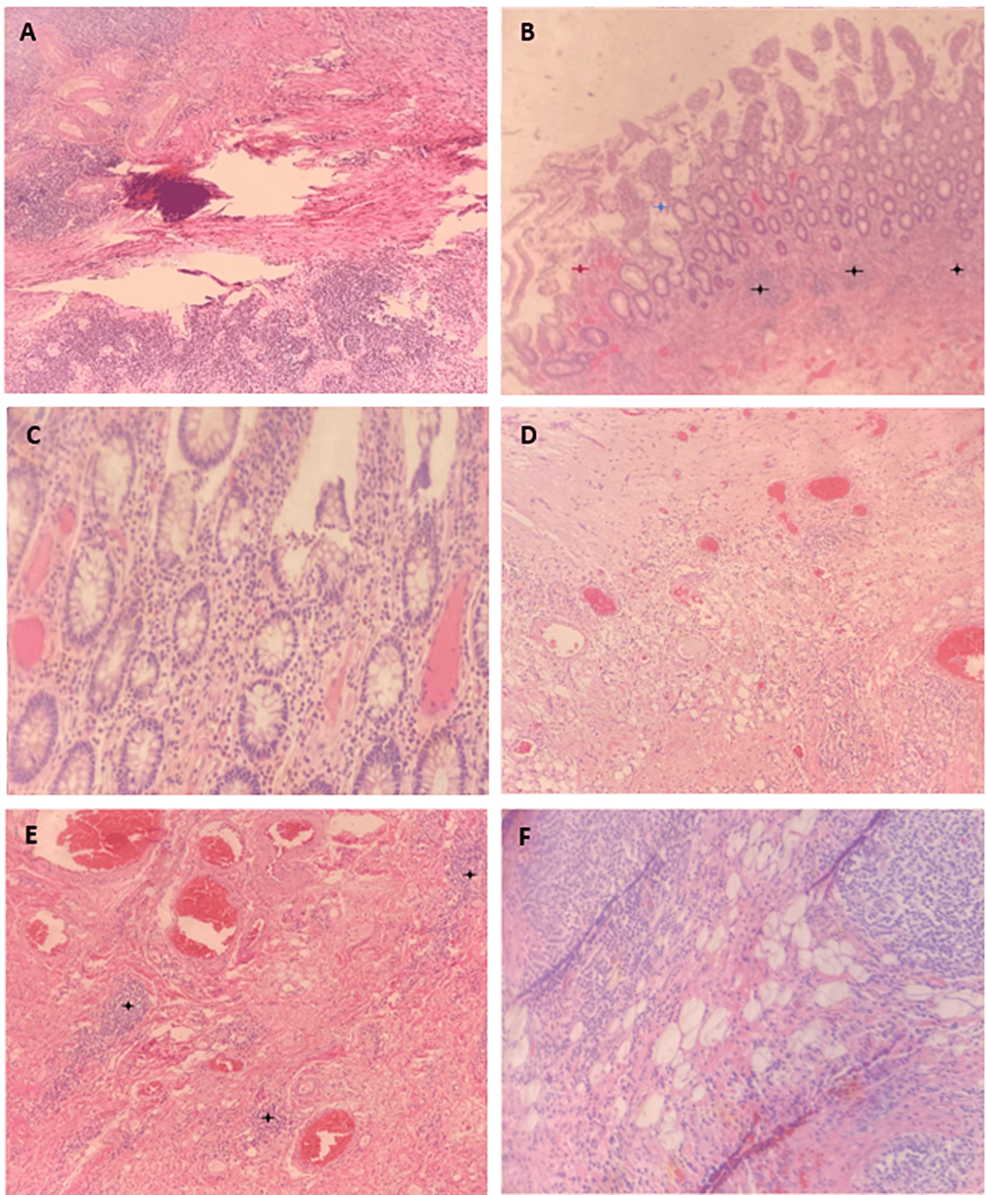 Cureus Tumefactive Crohn's Disease Mimicking Colon Carcinoma in a