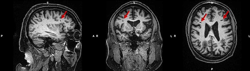 Cureus | Incidental Follow-up Imaging of Previous Ventricular ...