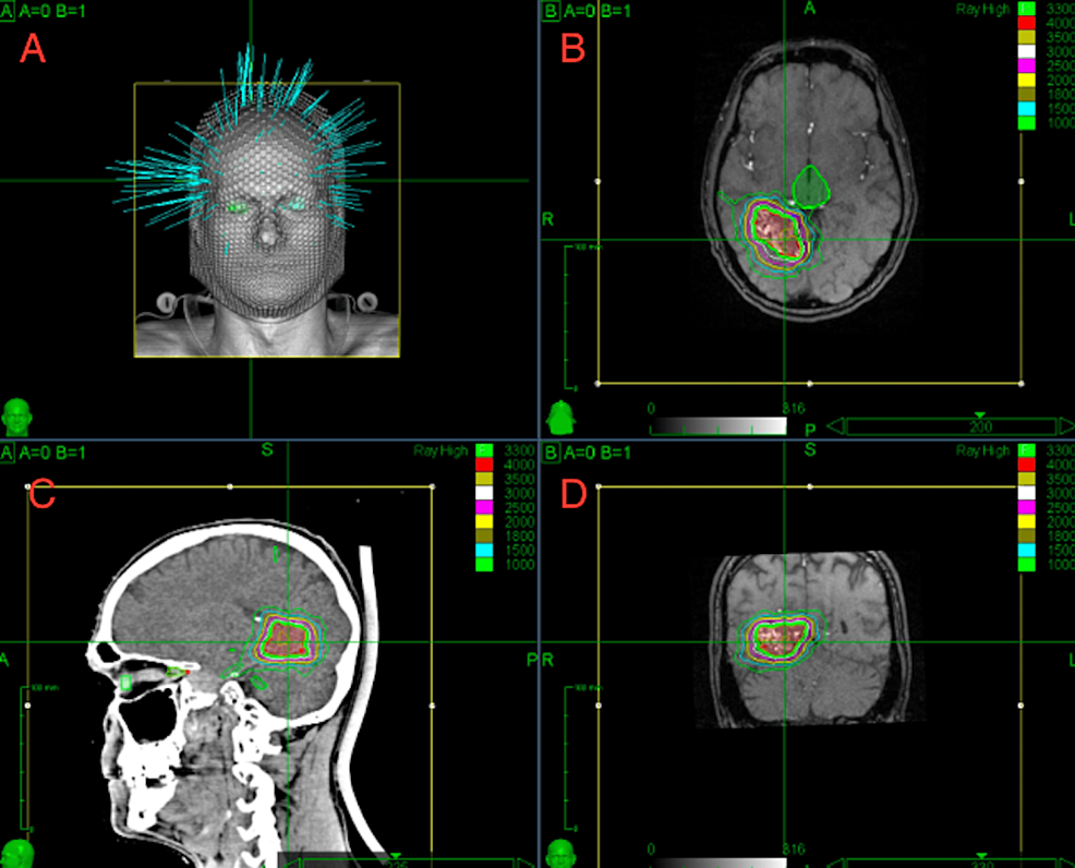 Efficacy of DoseEscalated Hypofractionated Radiosurgery for