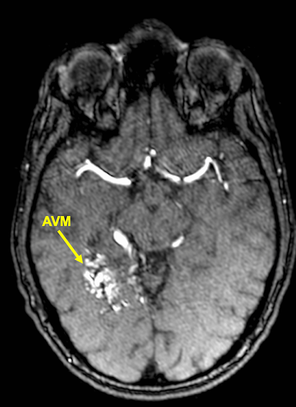 Efficacy of DoseEscalated Hypofractionated Radiosurgery for