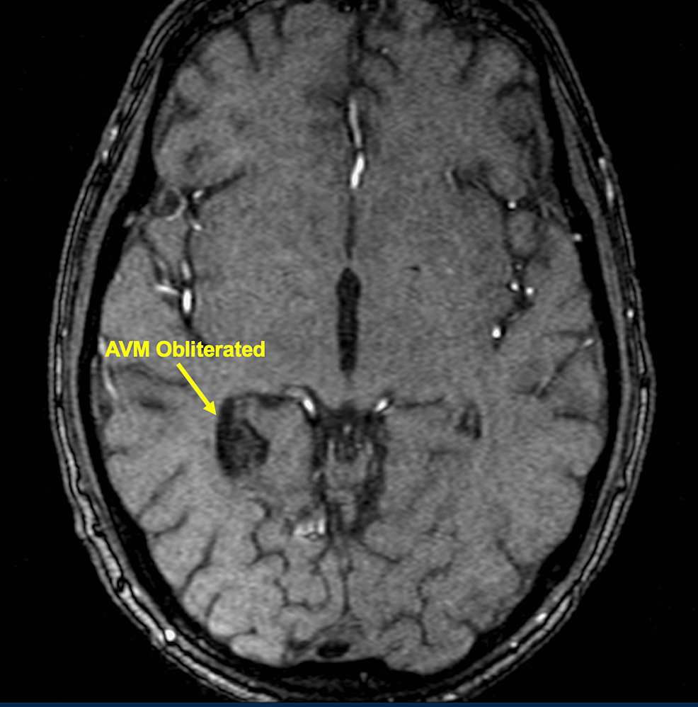 Efficacy of DoseEscalated Hypofractionated Radiosurgery for