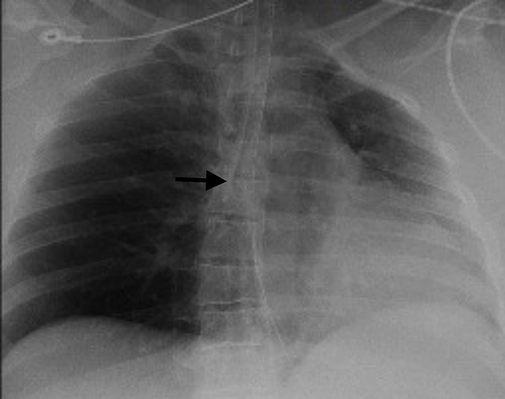 cureus-an-unusual-case-of-iatrogenic-tracheal-diverticulum-found-in-a