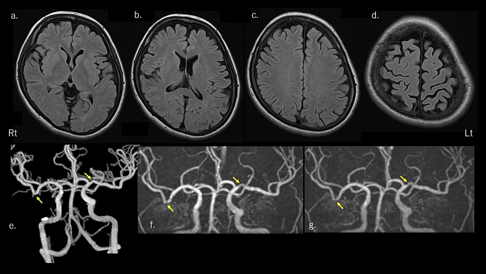 Cureus A Case of Migraine Aura Status in a Migraine Patient With