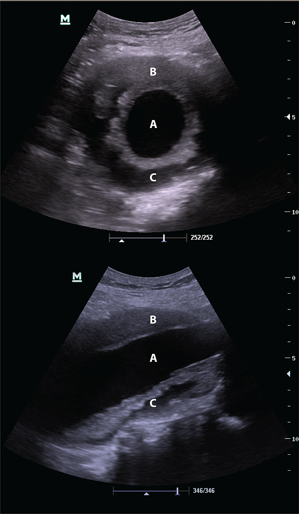 Cureus Point Of Care Ultrasound Trumps Computed Tomography In A