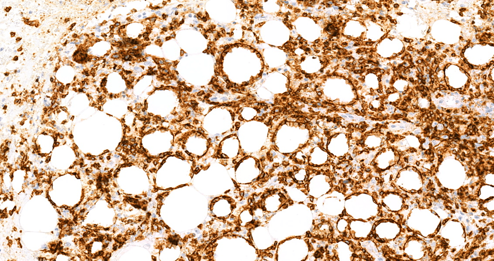 Cureus | a case of subcutaneous panniculitis-like t-cell lymphoma with