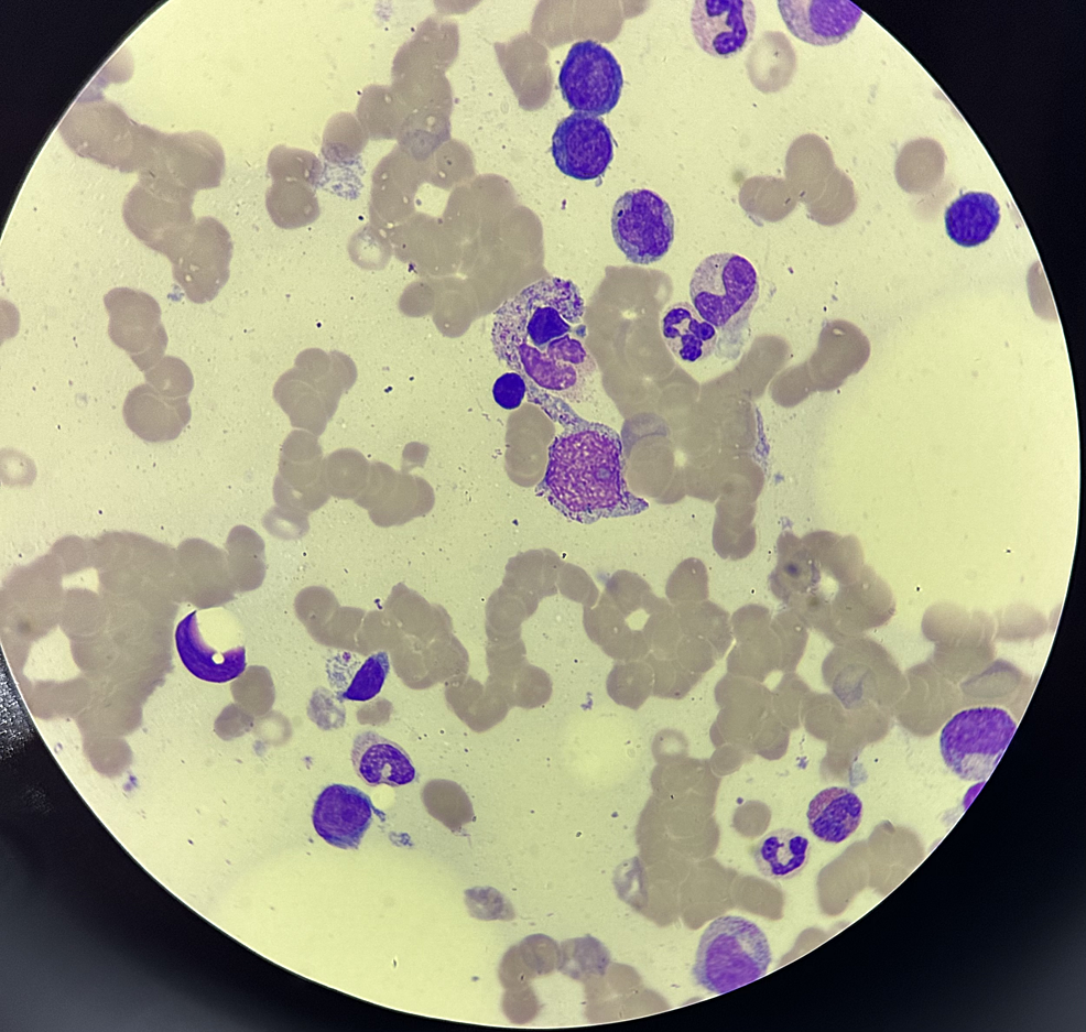 Cureus | a case of subcutaneous panniculitis-like t-cell lymphoma with