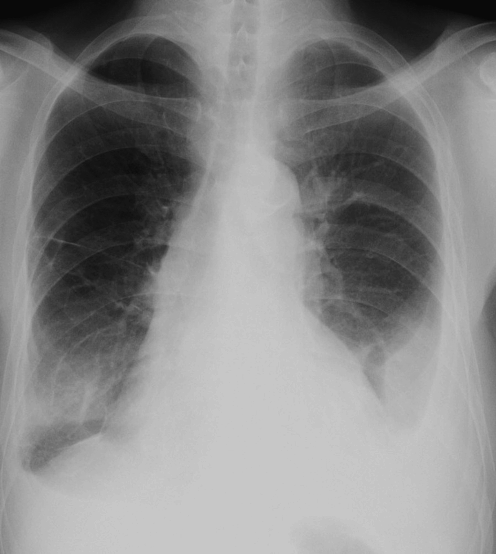 Cureus Ascites Pleural And Pericardial Effusion In Primary