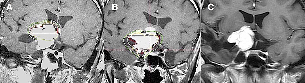 Coronal-MRI-revealing-a-sphenoidal-meningioma-in-a-19-year-old-male-after-surgical-resection.-