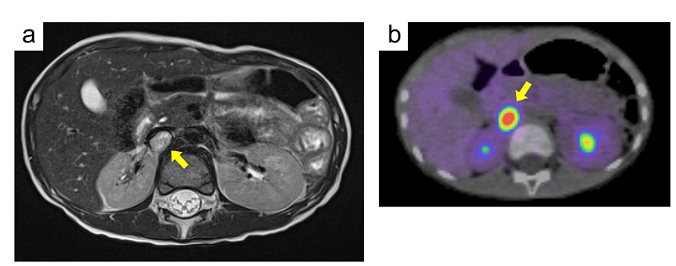 フォン・ヒッペル・リンダウ症候群の見通し