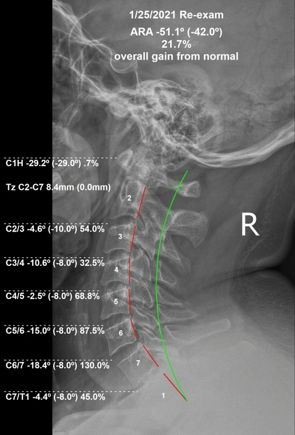 Subjective And Objective Improvement In A 39-Year-Old Male Suffering ...