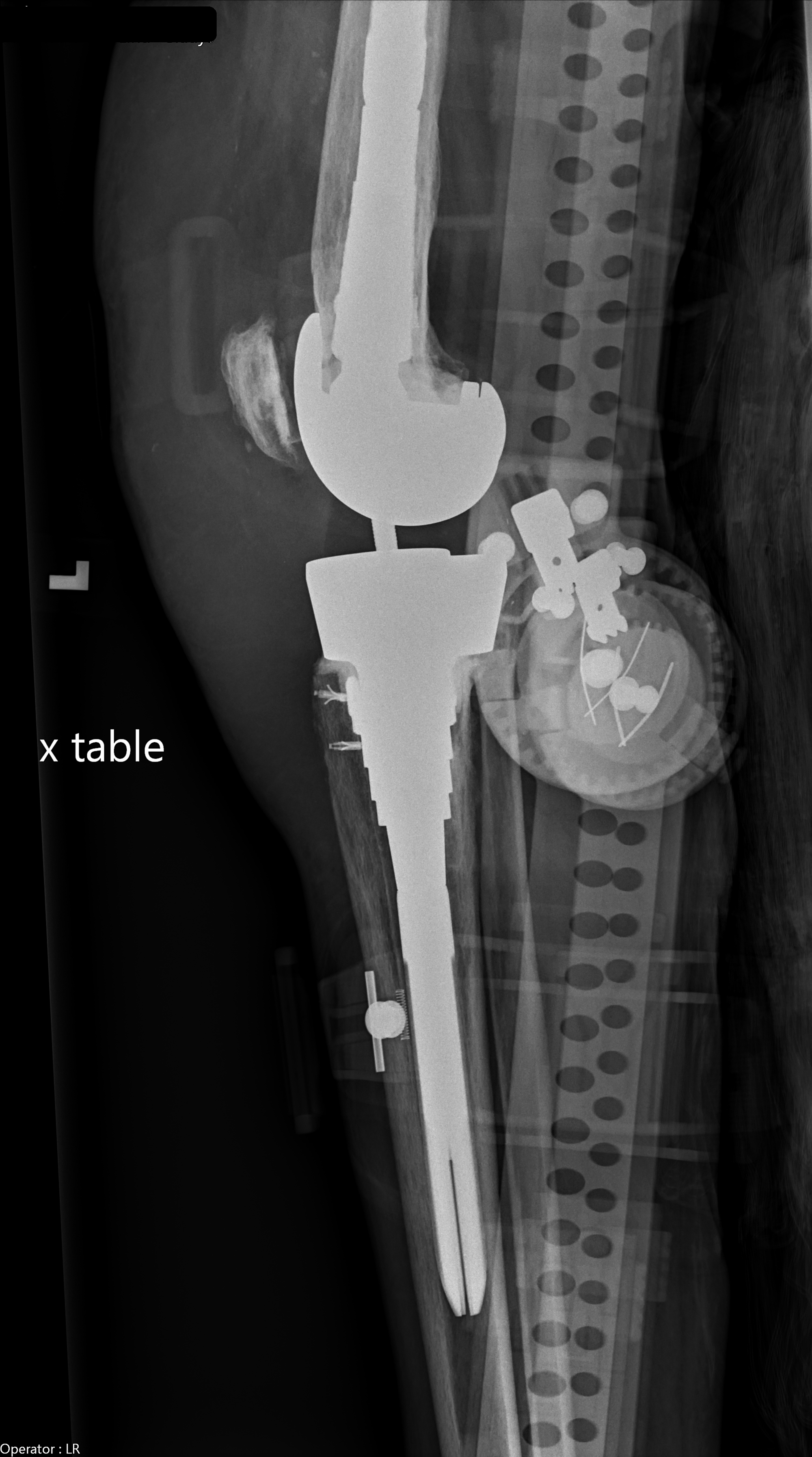 Cureus Rare Occurrence of Prosthetic Knee Septic Arthritis Due to
