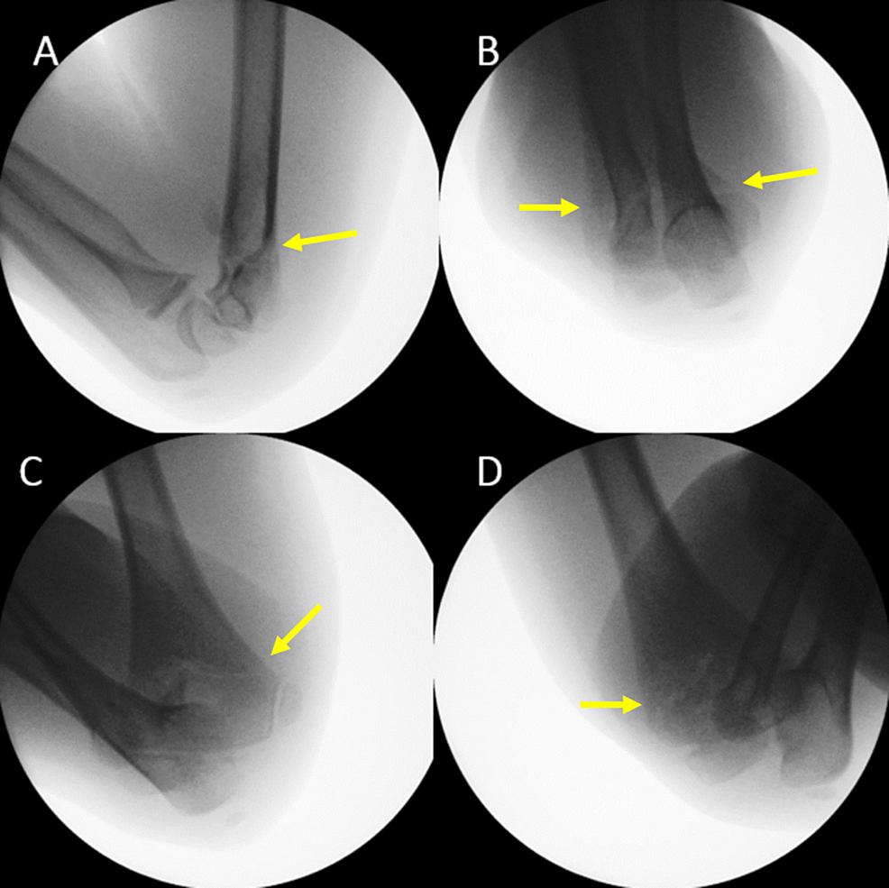 Cureus Role of the Posterior Fat Pad Sign in Treating Displaced