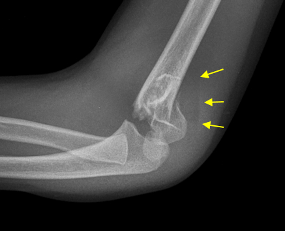 Cureus | Role of the Posterior Fat Pad Sign in Treating Displaced