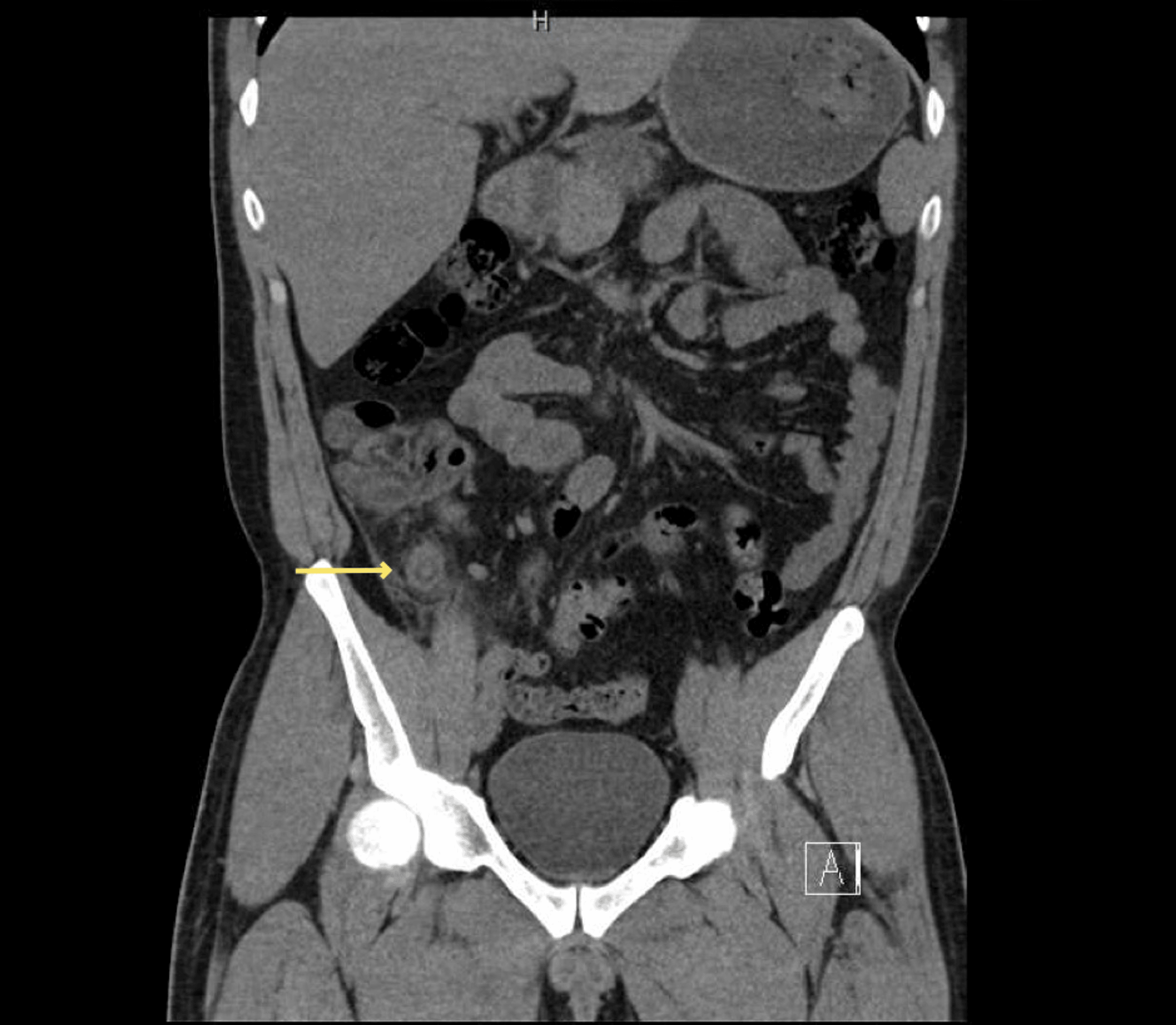 Cureus | Stumped by Appendicitis: A Rare Cause of Acute Abdominal Pain