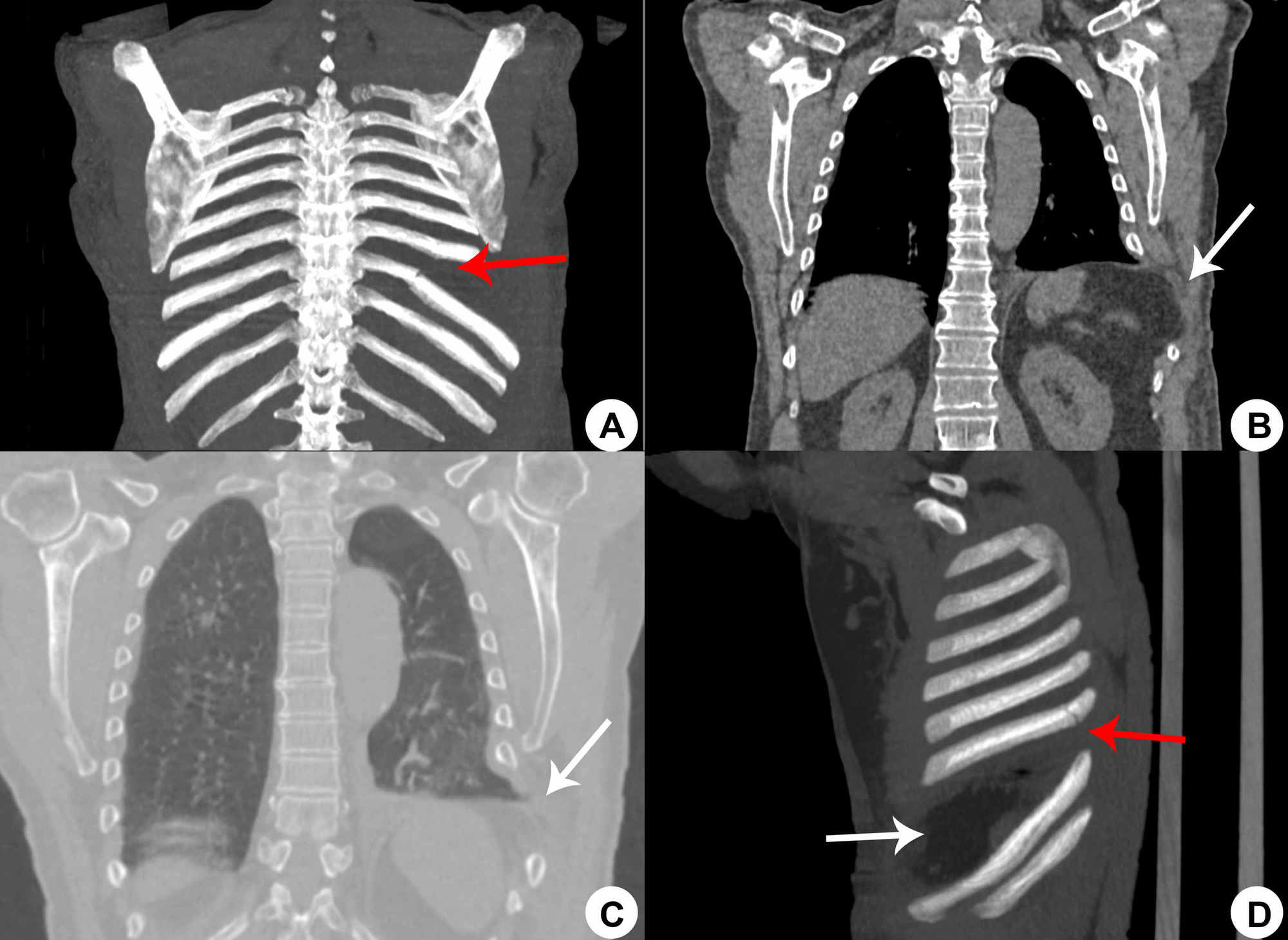 Rib Fracture Ct Scan