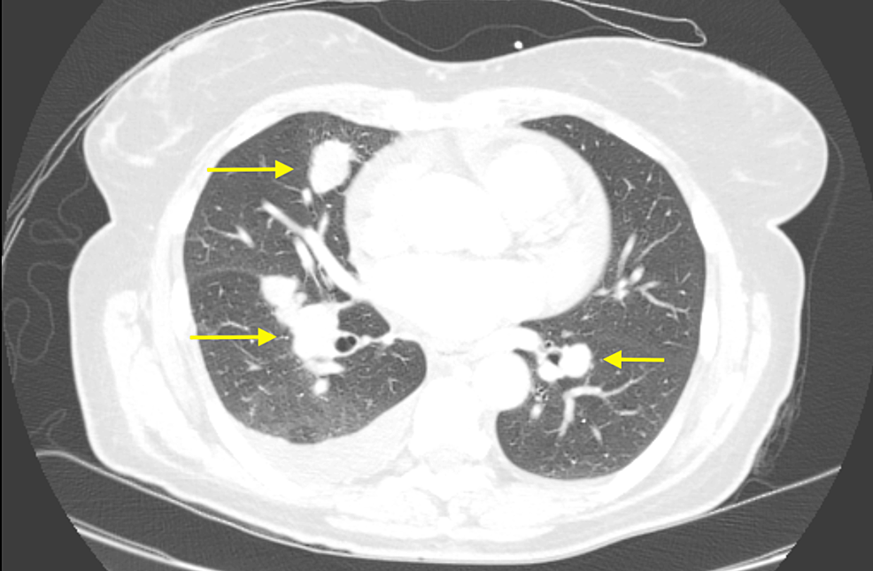 Cureus Response to Immunotherapy in Sclerosing Epithelioid