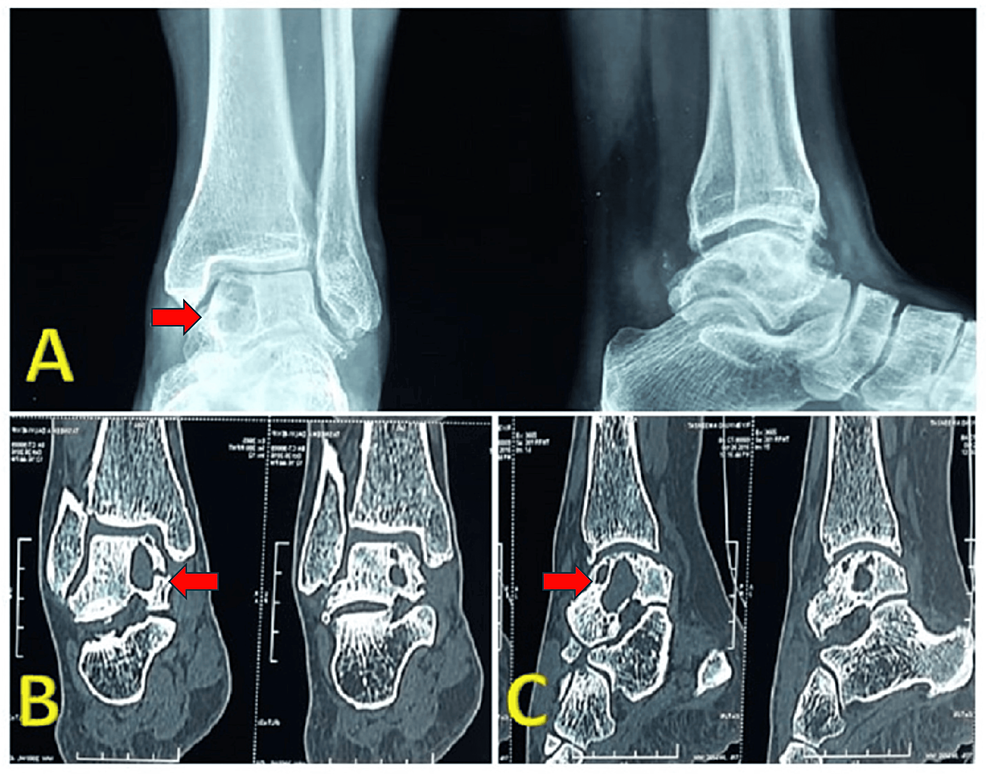 Novel Surgical Approach for Large Intraosseous Subchondral Cysts of