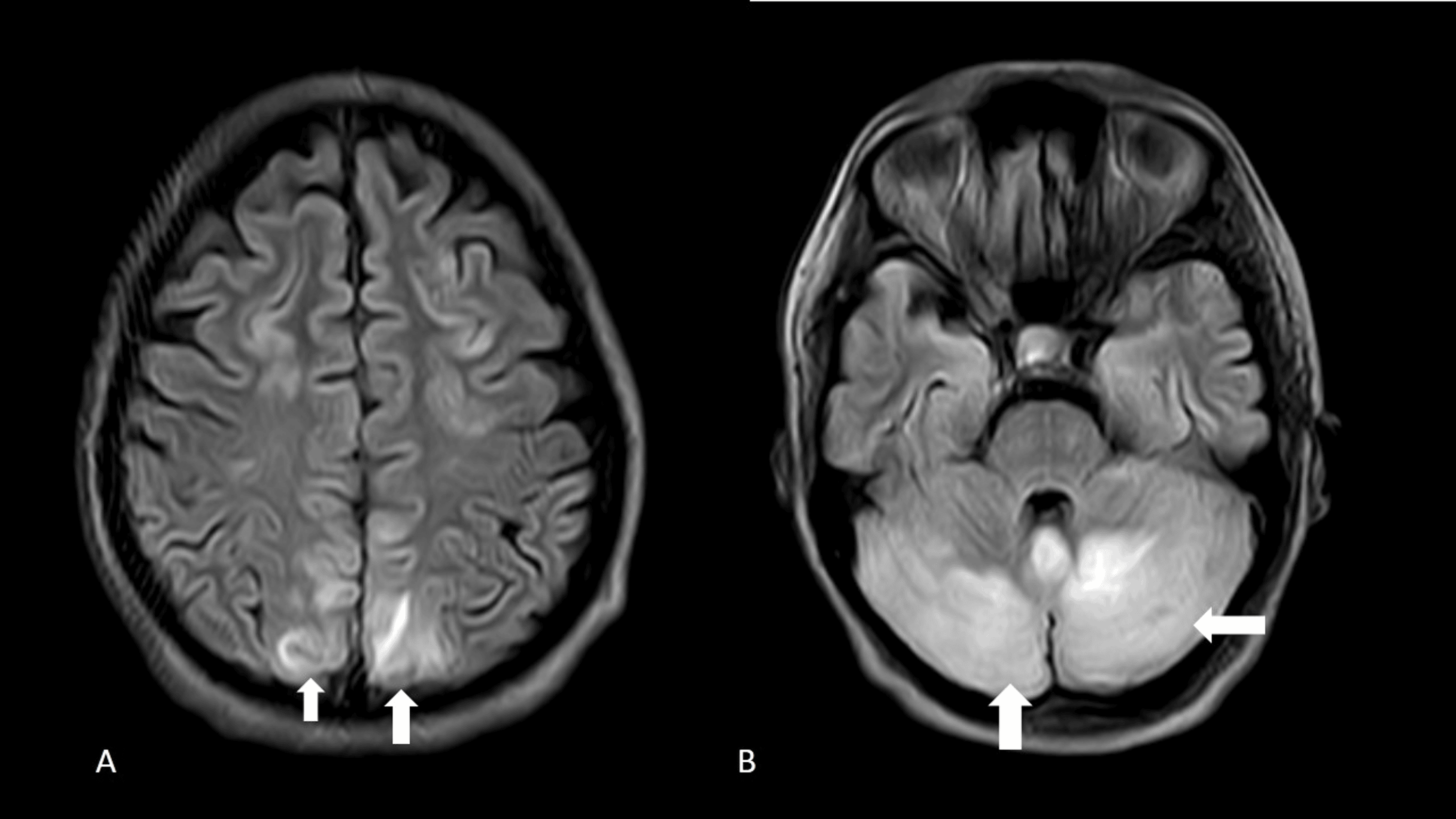 Choroidopathy And Retinal Detachment: A Rare Sighting In A Case Of ...