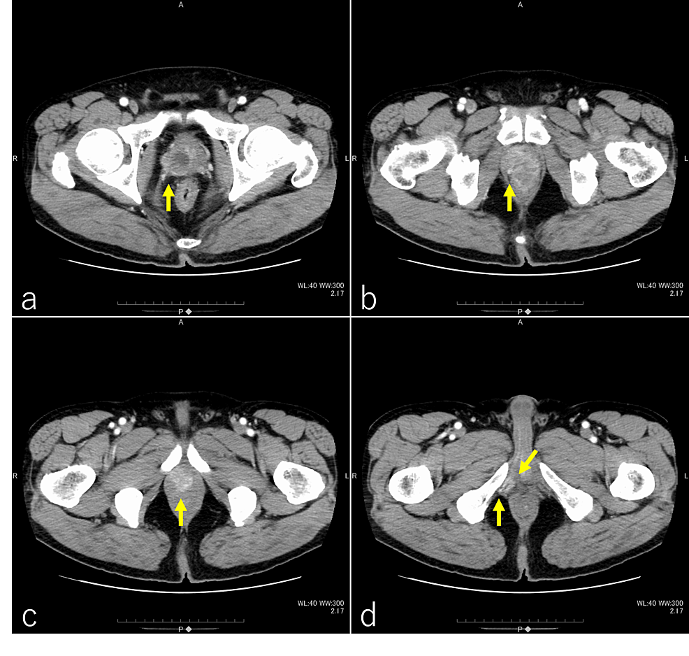 Long-Term Control With Proton Beam Therapy for Recurrent Prostate Cancer in the Right Perineum Following Intensity-Modulated Radiation Therapy: A Case Report