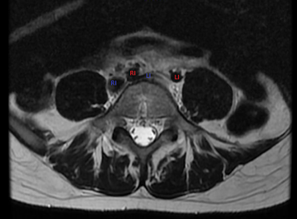MRI-of-the-lumbar-spine-again-noting-flattening-of-the-left-common-iliac-vein-(blue-LI)-by-the-right-iliac-artery-(red-RI).-Right-common-iliac-vein-(blue-RI)-and-left-iliac-artery-(red-LI)-also-noted.-