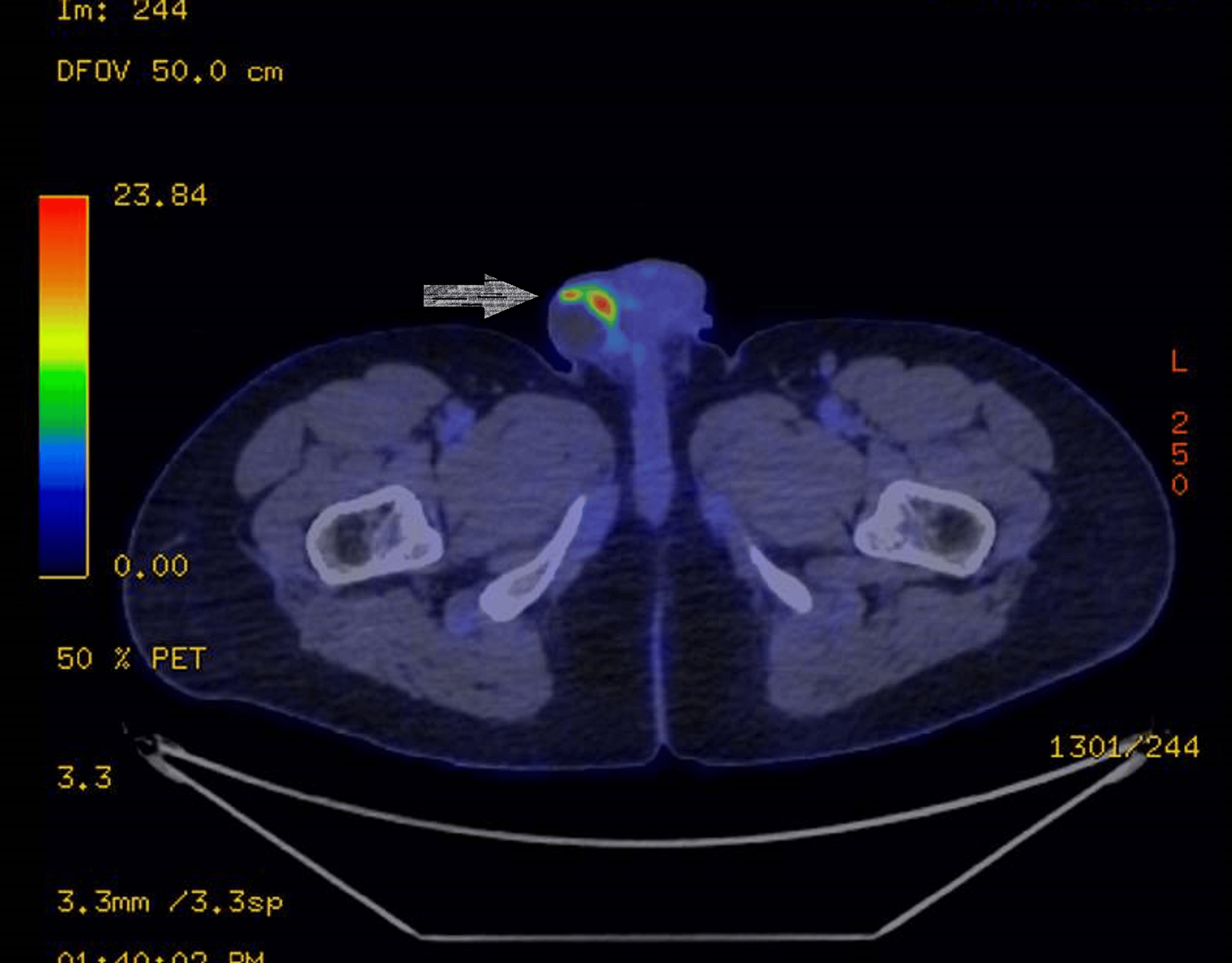 A Rare Case of Ipsilateral Scrotal Recurrence of Testicular Cancer