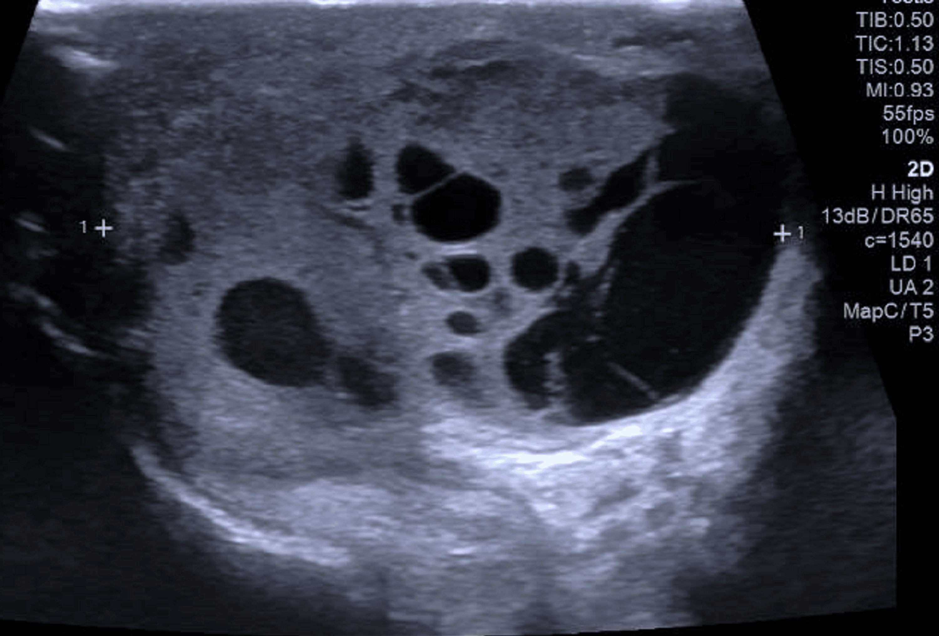 A Rare Case Of Ipsilateral Scrotal Recurrence Of Testicular Cancer