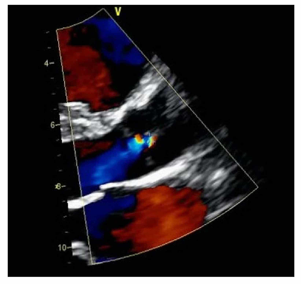 Transthoracic-color-Doppler-echocardiogram-showing-mild-aortic-regurgitation
