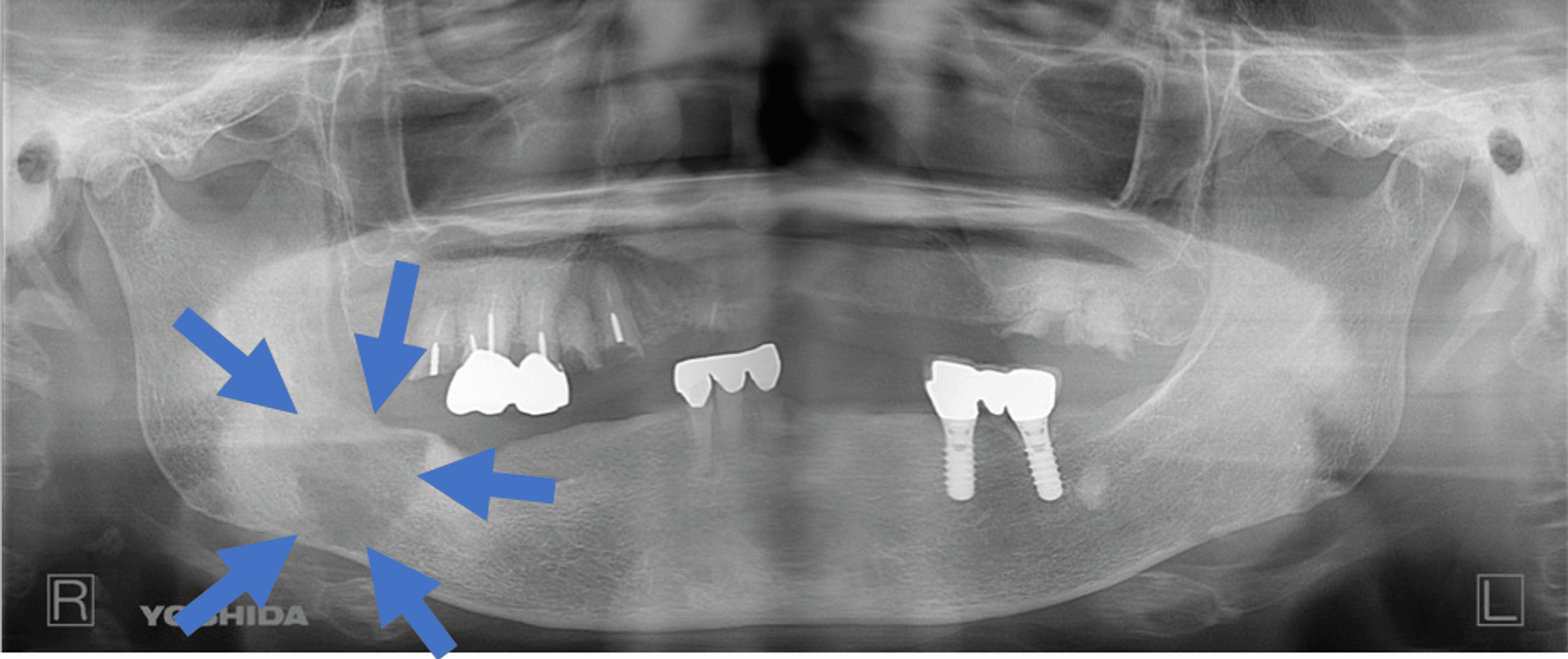 A Case of Spindle Cell Squamous Cell Carcinoma Manifesting in the Mandible Following Resection