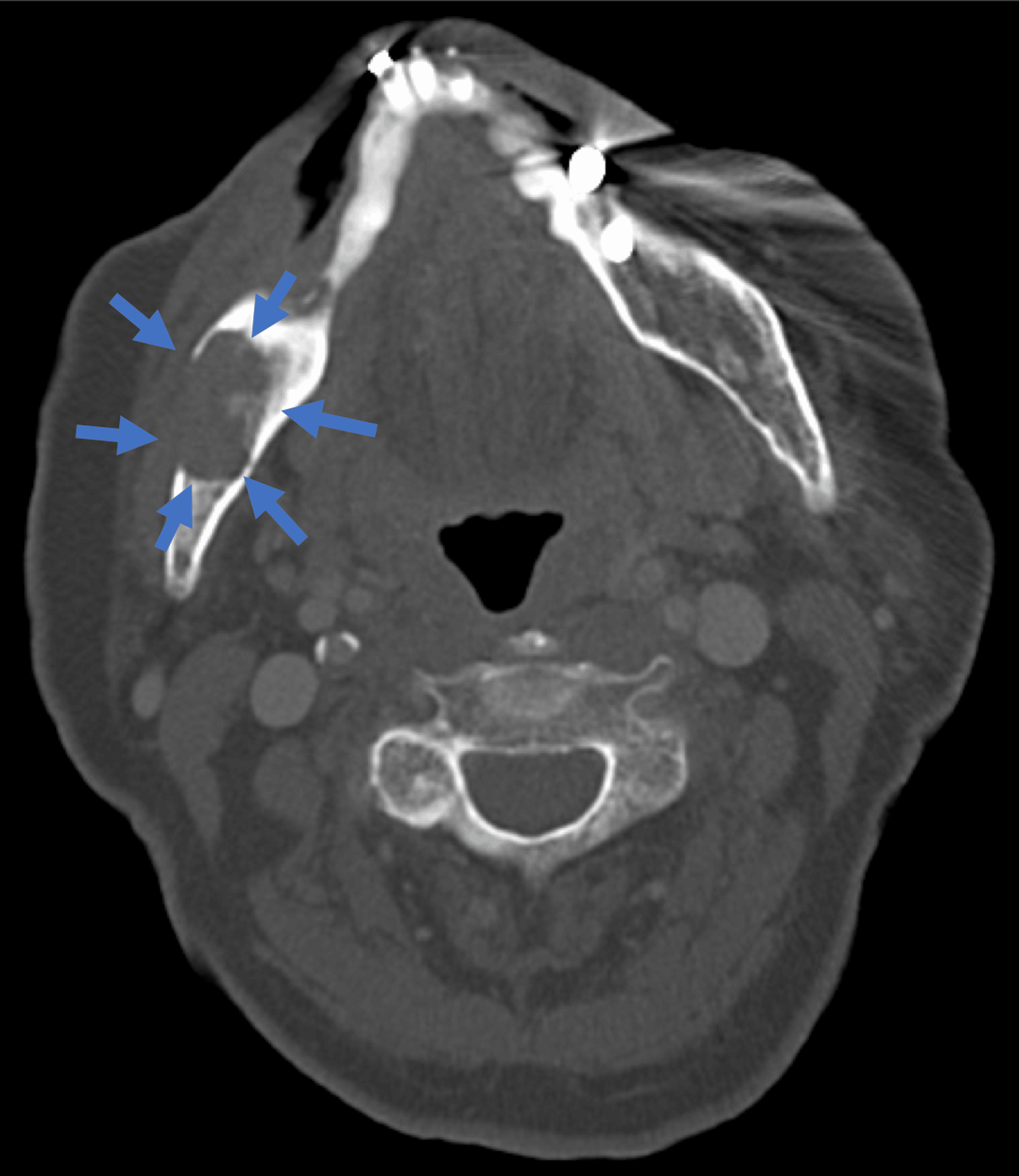 A Case of Spindle Cell Squamous Cell Carcinoma Manifesting in the Mandible Following Resection