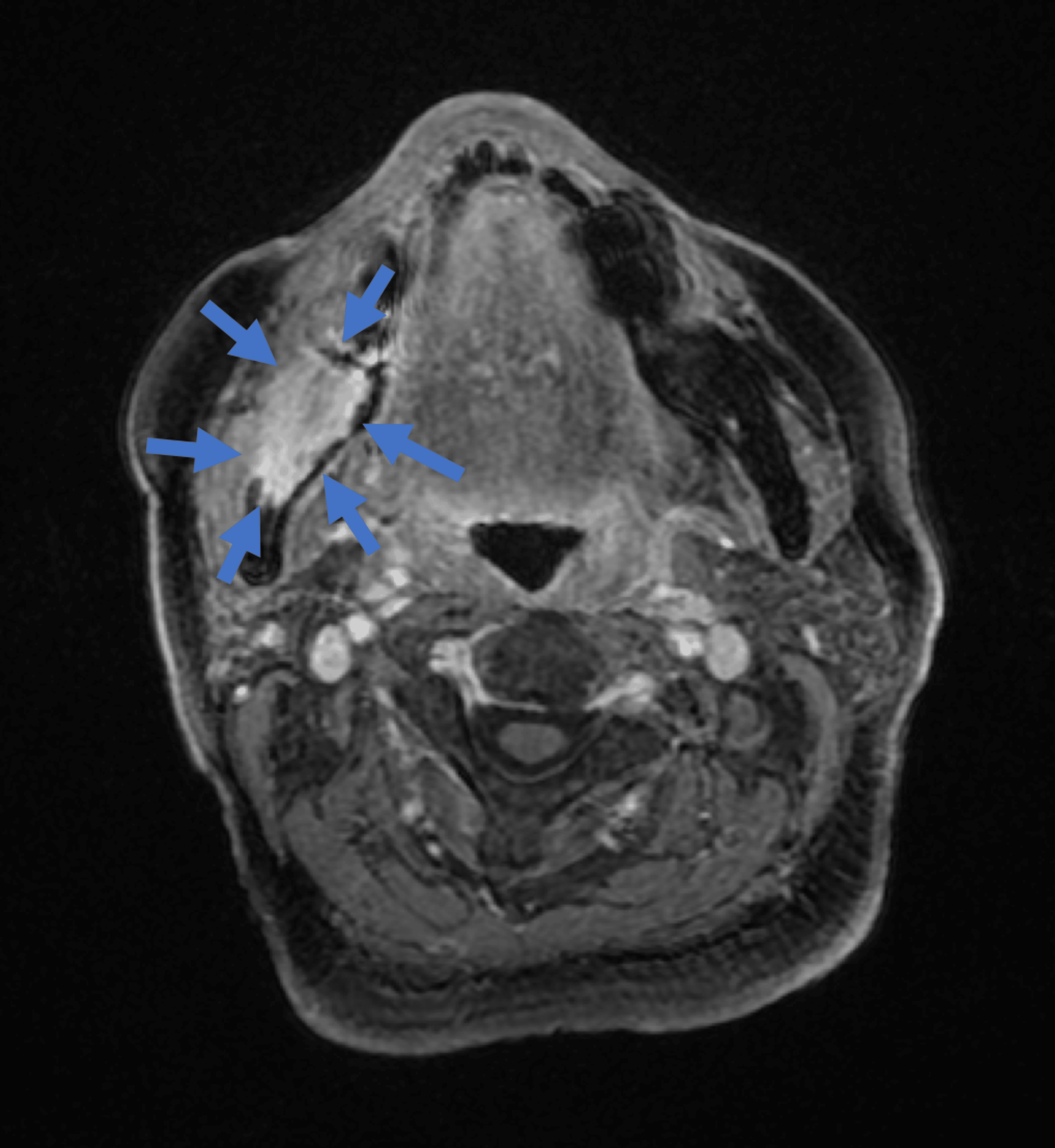 A Case of Spindle Cell Squamous Cell Carcinoma Manifesting in the Mandible Following Resection
