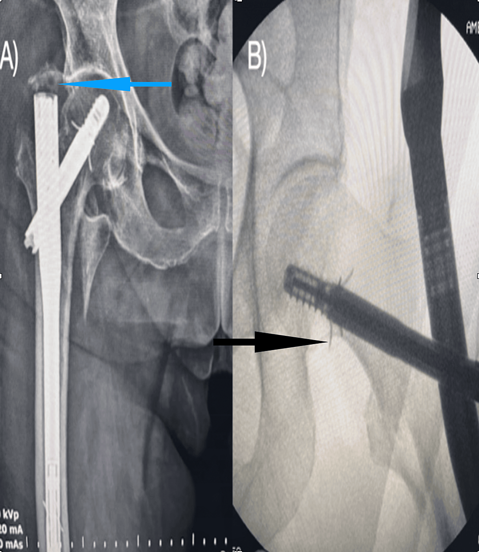 Surgery to Repair a Hip Fracture: Learning about